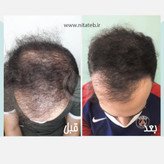 کوکتل هیرمن مزولایک HairMan